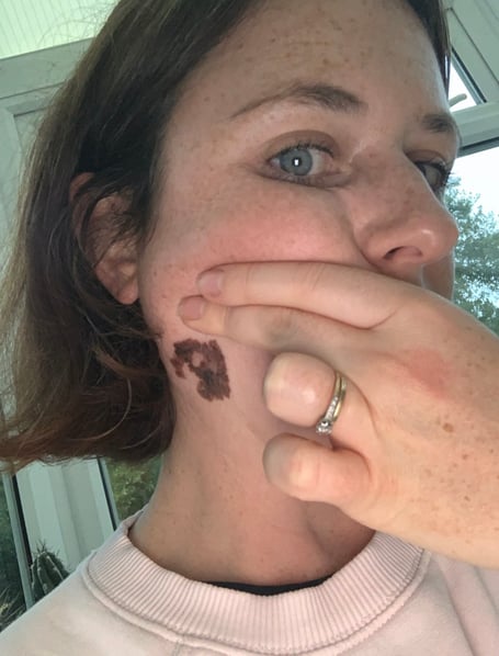 Sarah Goldup's skin cancer.