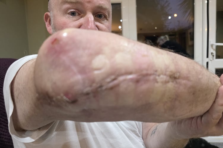 Some of the injuries Jason Nicholas sustained in a crash near Alton.